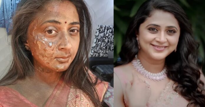 what-happened-to-kanika-subramaniam-face-full-of-burns